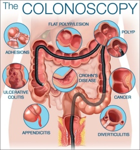 Diagram of a Colonoscopy